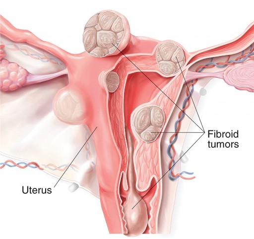 fibroid illustration