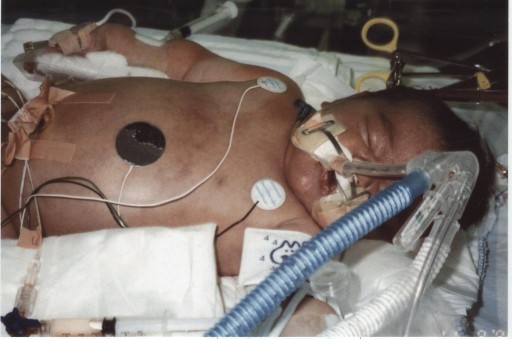 baby in ECMO